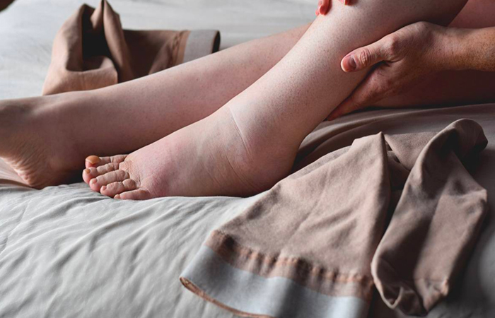oedema